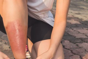 Persona con celulitis infecciosa en la pierna