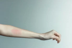 Imagen de un brazo con las líneas propias del dermografismo
